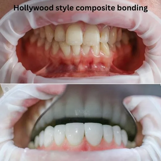 composite-bonding-Turkey-package-antalya